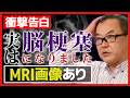 【衝撃告白】実は私も脳梗塞になりました【MRI画像あり】