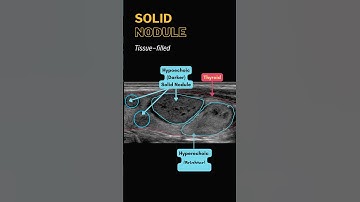 Thyroid Nodule Ultrasound - Cystic, Solid, Complicated, Calcifications