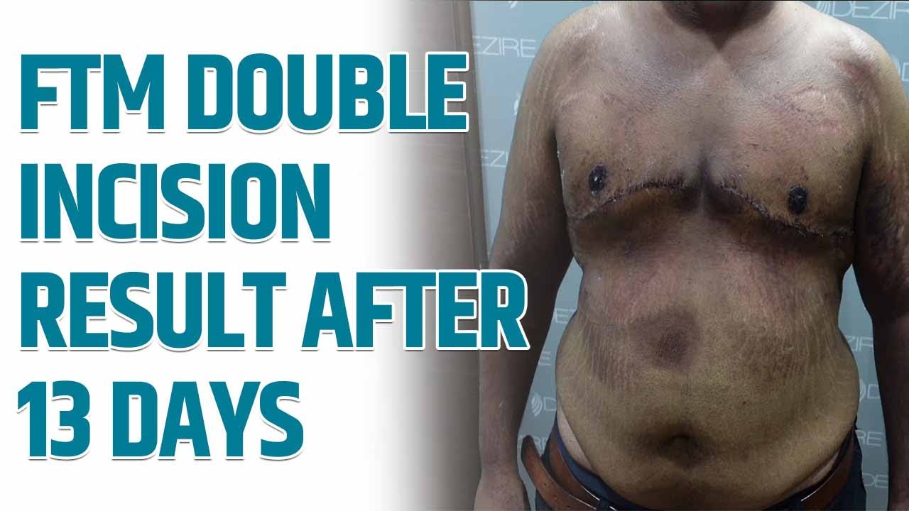 Female to male TOP Surgery result After 13 days
