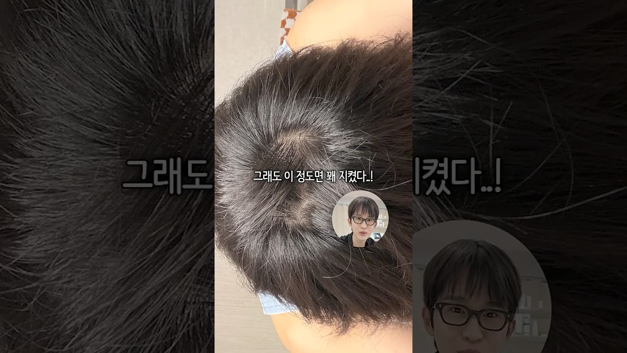 탈모관리 8년차, 머리를 지켜준 5가지