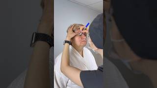 Разметка перед выполнением блефаропластики верхних век 👁️
