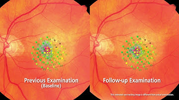 Nidek MP-3 Microperimeter