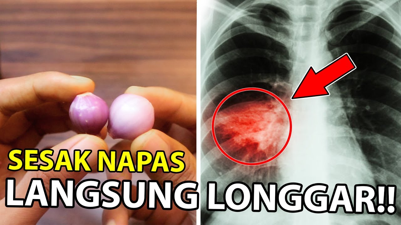 Cara Mengobati Sesak Napas Dan Batuk 