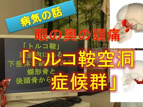 トルコ鞍空洞症、エンプティ・セラ症候群とは【肩甲骨はがしで評判。横浜・菊名の整体院一宇～ITIU～】