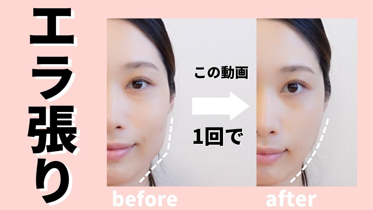 エラ張 No need for Botox! Transform your face line in just one session