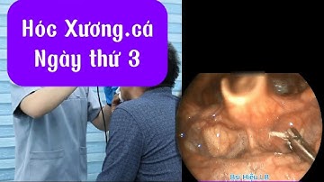 Hóc Xương.cá ngày thứ 3 耳かき - ASMR耳掃除 | Bác sĩ Hiệu Long Biên