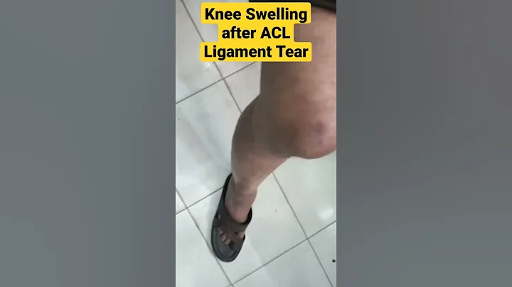 Knee Swelling ACL Ligament Tear | Knee Effusion| #aclsurgery#kneeswelling  #ligamentinjury#mbbs#acl - DayDayNews