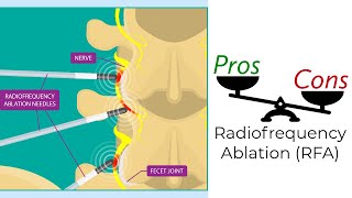 Radiofrequency Ablation  Pros & Cons