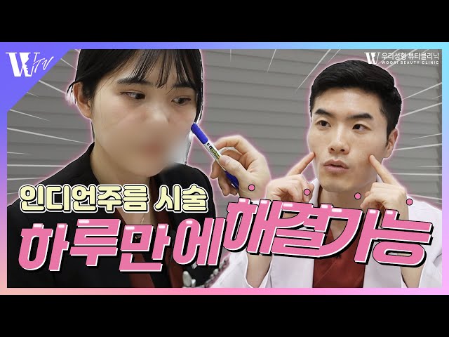 인디언주름 시술로 하루만에 해결가능 | 우리성형외과
