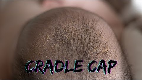 Cradle cap causes crusty or oily scaly patches on a baby's scalp. Infantile seborrheic dermatitis.