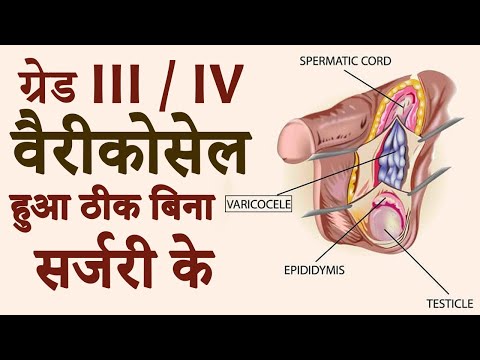 वीडियो: ग्रेड कैसे ठीक करें