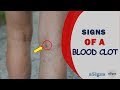 10 Signs Of A Blood Clot