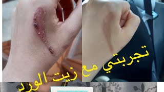 تجربتي مع زيت الورد لازالة آثار الحروق?? /منتجات نشريها او لا 4k