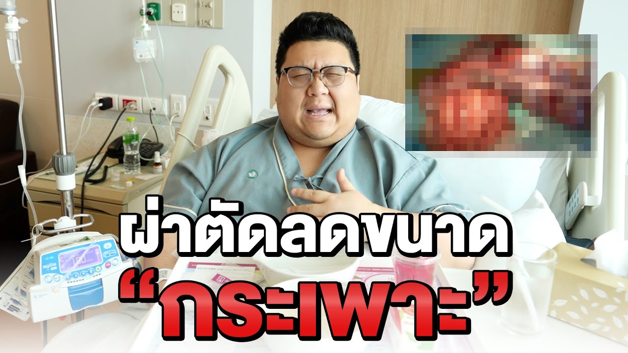 รีวิว ผ่าตัดลดขนาดกระเพาะ แบบละเอียด EP.1