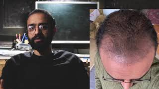 FUE Hair Transplant الفيديو الرابع| بعد العملية بثلاث شهور | يوميات أصلع من الدرجة الرابعة