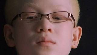 Albinism: Caught Between Dark and Light