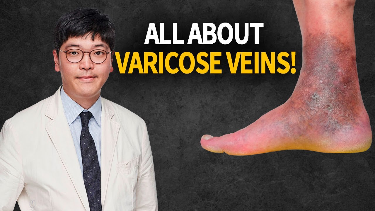 Varicose Veins The Facts You Need to Know! - YouTube