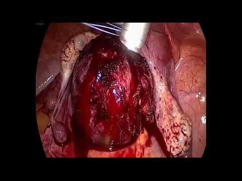 A combination of two novel ligation techniques for complicated laparoscopic intraligamental...