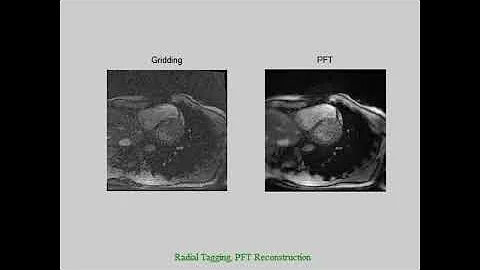 PFT vs Conventional reconstruction