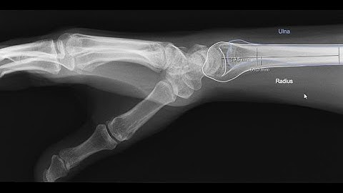 Precision Measurement of Radiographic Parameters in the Evaluation of Scapholunate Dissociation