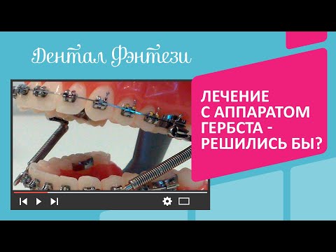Wideo: 3 sposoby dbania o aparat ortodontyczny