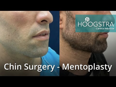 Video: Ano Ang Mentoplasty?