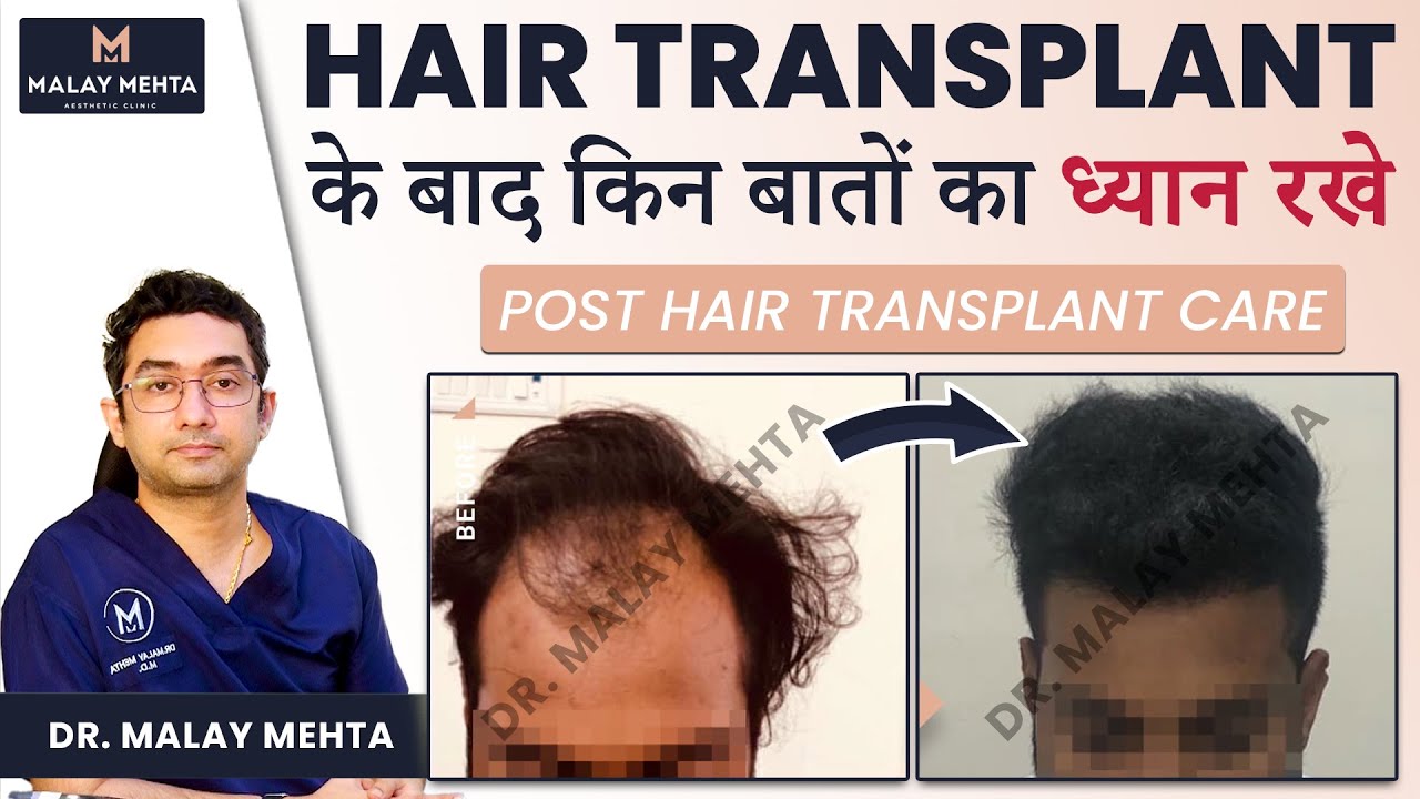 Precautions Post Care After Hair Transplant In Hindi Best Hair Transplant In Mumbai YouTube