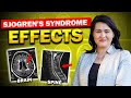 Sjogrens syndrome affects the brain and spine