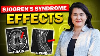 Sjogren's Syndrome Affects the Brain and Spine
