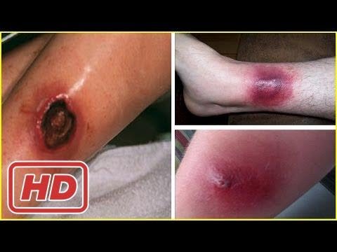 [Healthy Life]How to Treat Spider Bites - 5 Home Remedies for Spider Bites
