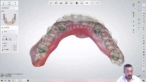 Design method of full arch implant superstructure and coloring method of monolithic zirconia.