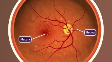 Animation: Age-related Macular Degeneration