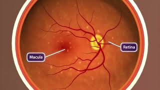 Animation: Age-related Macular Degeneration