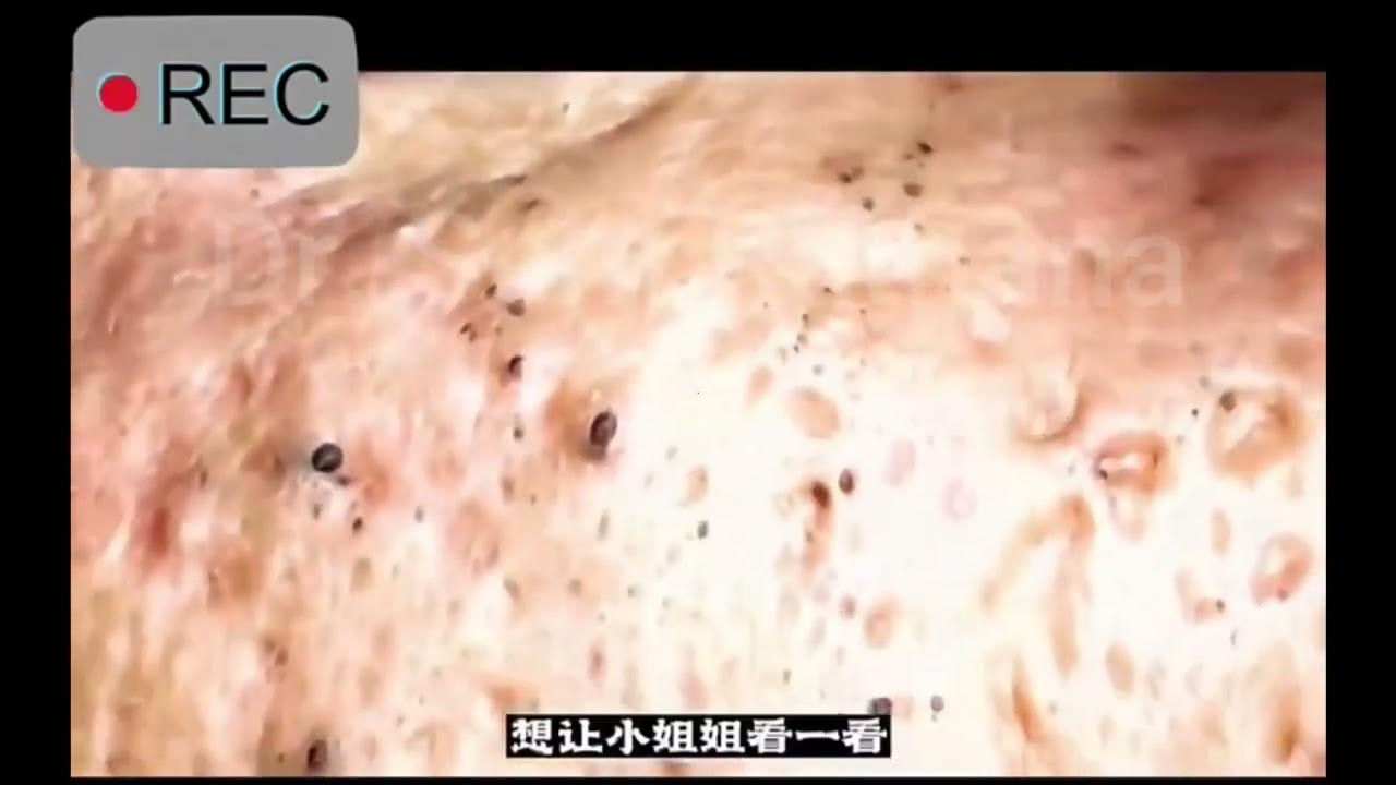 BIG BLACKHEADS Removal Very Satisfying Removal Hidden Blackheads and