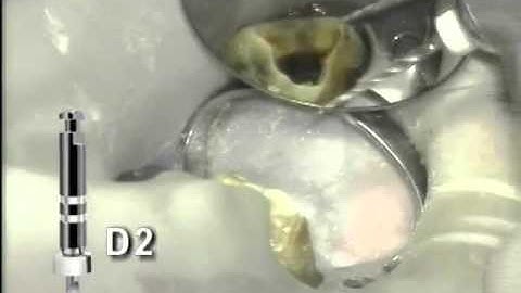 Retreatment using ProTaper® Universal Retreatment Files | Dentsply Sirona