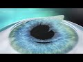 Лазерная коррекция зрения Femto-LASIK