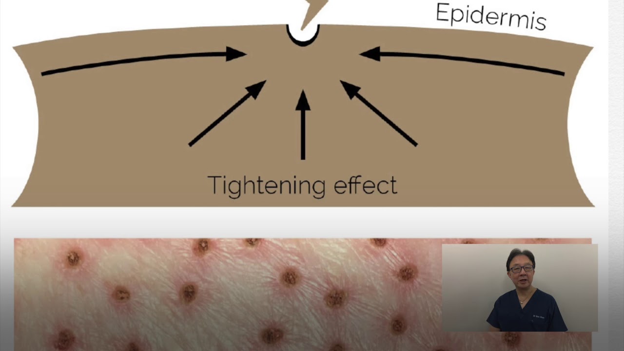 Plasma pen explained