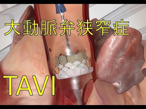 大動脈弁狭窄症のカテーテル治療1 TAVI