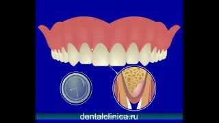Лечение зубов имплантация в Москве Санкт-Петербурге европейское качество протезирование стоматология(, 2014-03-28T22:26:00.000Z)