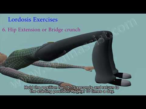 Lumbar Lordosis, Its Causes, And Exercises