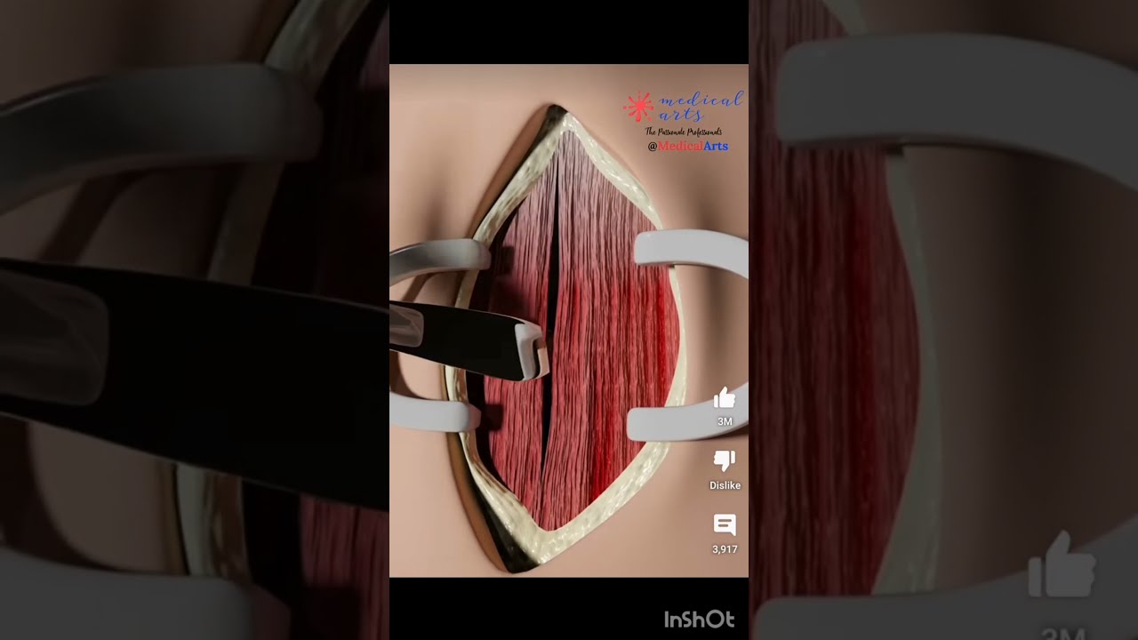 Tracheostomy Procedure 3D Animation