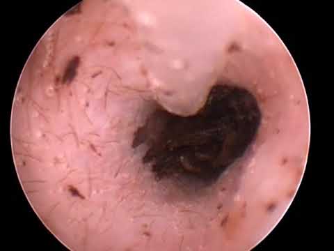 Winston's left ear video otoscope ear canal flush