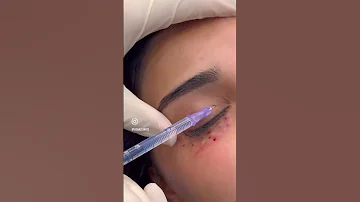 تجميل من أفضل الجلسات لعلاج الهالات انوفيال Innovyal 