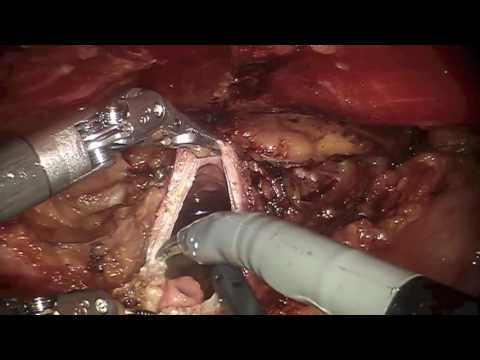 Robotic urachus operation and Umilicoplasty