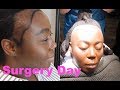 My Hair Transplant Surgery Day/ Mateyena