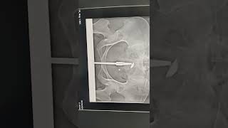 “HSG Test in Radiology | Fallopian Tube Patency Check”
