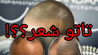 تغطية صلع وراثي جزئي باستخدام تقنية SMP - Scalp Micropigmentation