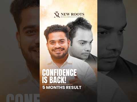 Hair Transplant in Kolhapur: 2500 Grafts | Grade 3 and Crown Baldness | #hair #viral #shorts
