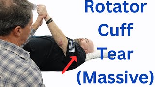 Massive Rotator Cuff Tear (Classic signs)