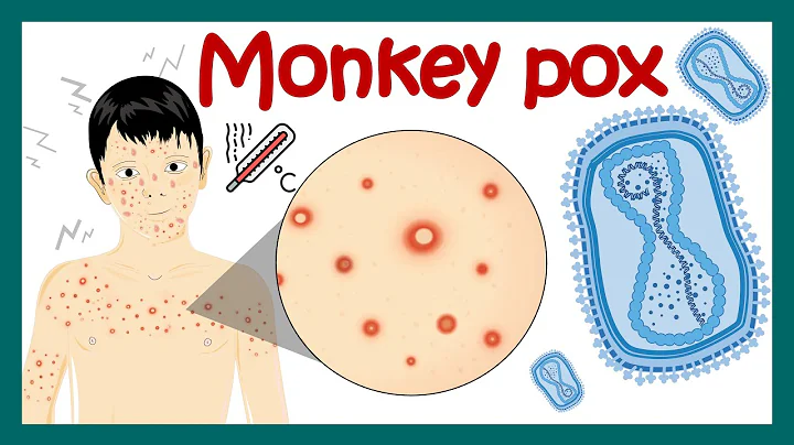 Monkey Pox Virus | How monkeypox is transmitted? | Symptoms and treatment of monkeypox | Rare virus - DayDayNews